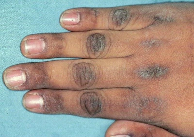 Đừng chủ quan với bệnh gai đen trẻ em giai đoạn đầu