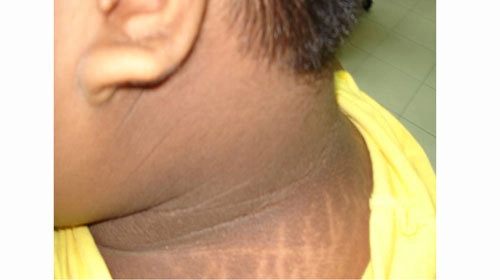 Xem rõ hình ảnh bệnh gai đen ở người trẻ dễ nhận biết