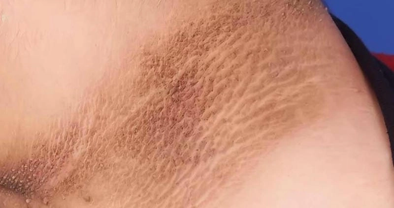 Xem hình ảnh bệnh gai đen tái phát và dấu hiệu kèm theo