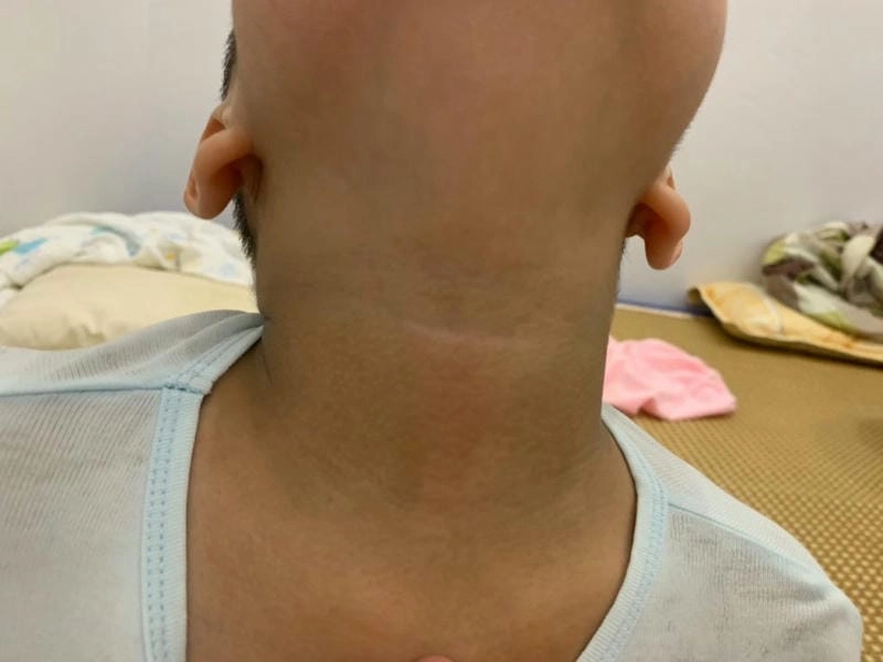 Xem ngay hình ảnh bệnh gai đen ở người châu Á phổ biến