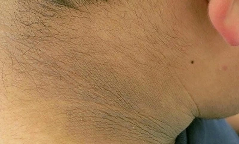 Xem ngay hình ảnh bệnh gai đen trên cổ rõ nét