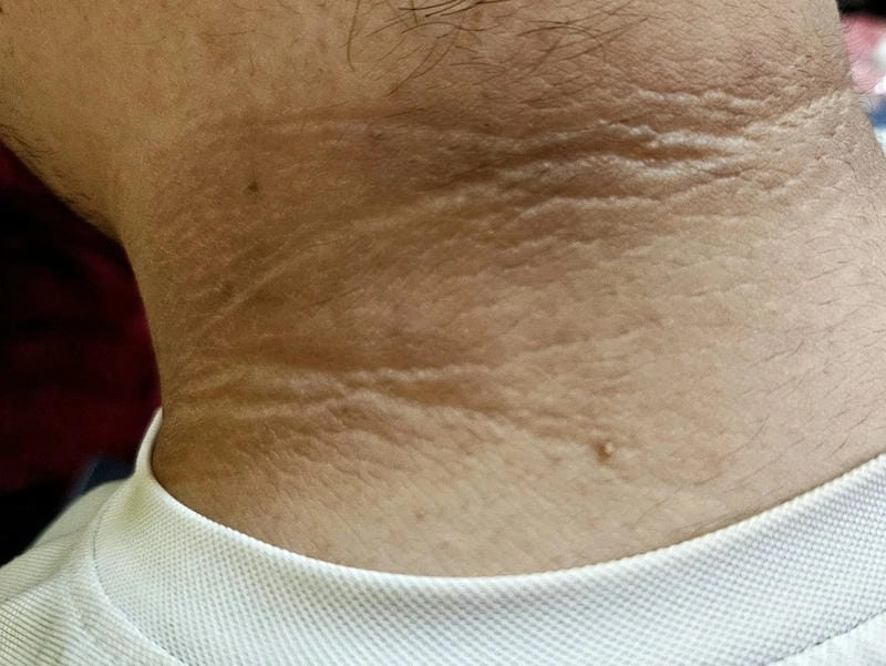 Tham khảo hình ảnh bệnh gai đen vùng cổ phổ biến