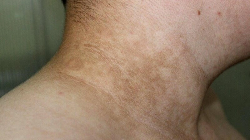 Giải đáp chi tiết bệnh gai đen là gì dễ hiểu