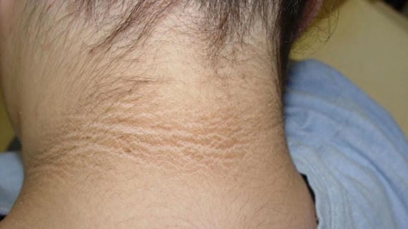 Hình ảnh thực tế bệnh gai đen ở nách và cách trị