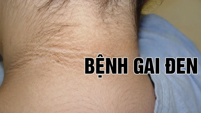 Nhận biết bệnh sớm qua hình ảnh bệnh gai đen thực tế