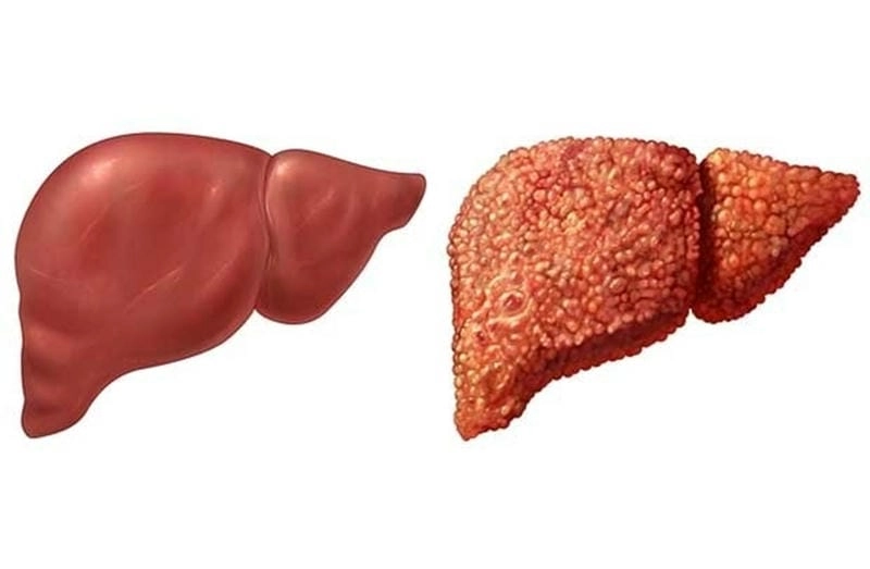 Khám phá hình ảnh gan nhiễm mỡ độ 2 rõ nét