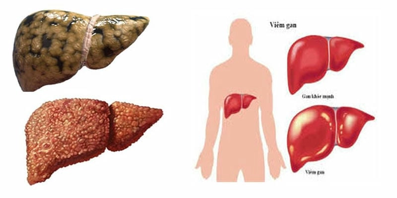 Nhận diện viem gan b bằng ảnh y khoa chi tiết
