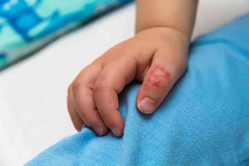 Ảnh bệnh ghẻ giúp nhận biết sớm triệu chứng