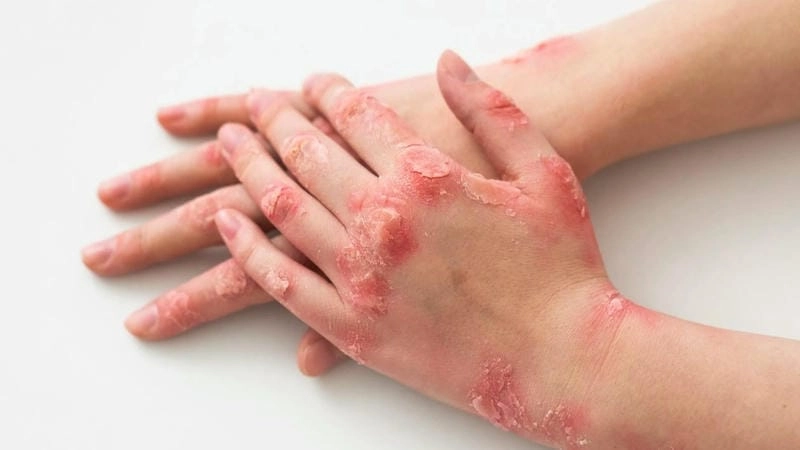 Hình ảnh người bị bệnh ghẻ có các nốt đỏ ngứa