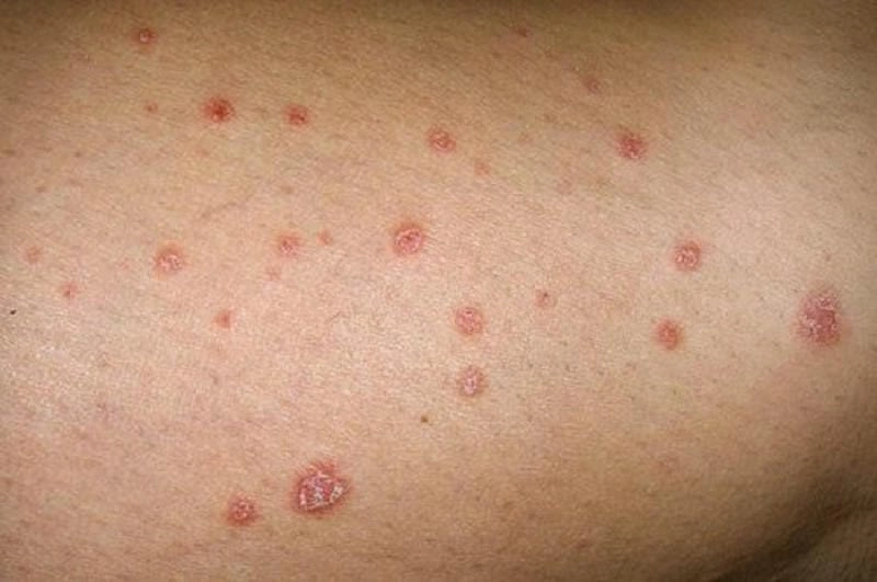 Hình ảnh bị ghẻ ở trẻ cảnh báo bệnh ngoài da sớm