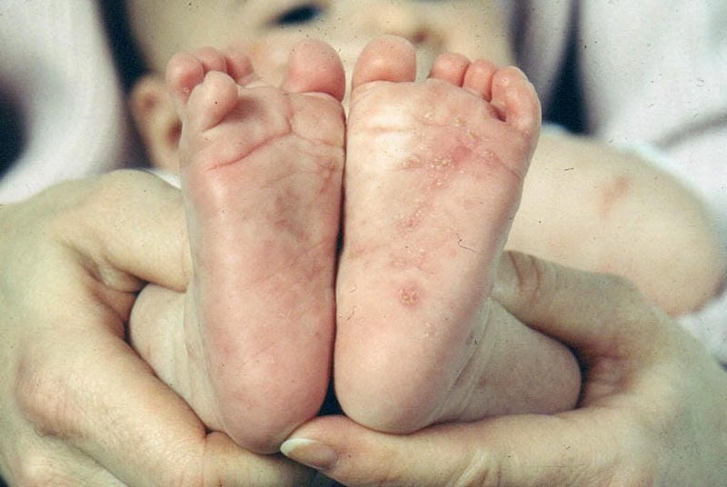 Hình ảnh bệnh ghẻ ngứa giúp phân biệt với viêm da