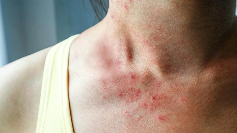 Hình ảnh bệnh ghẻ lở biểu hiện sưng loét da