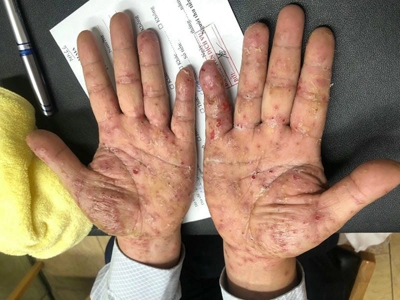 Tổng hợp các ảnh bị ghẻ với triệu chứng cụ thể