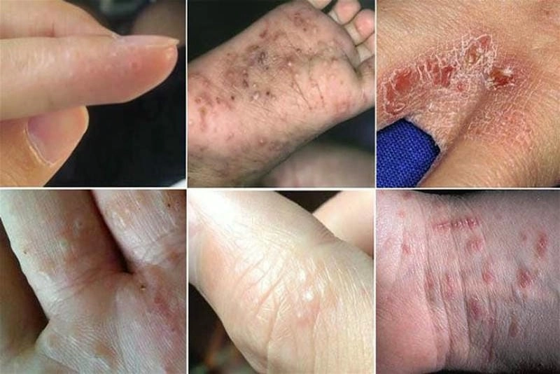 Tìm hiểu chi tiết qua hình ảnh ghẻ phổ biến hiện nay