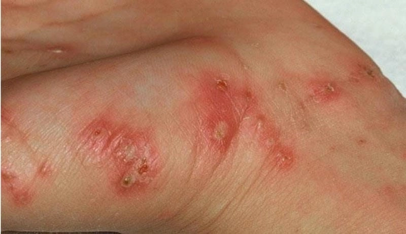 Hình ảnh cái ghẻ di chuyển dưới lớp biểu bì da