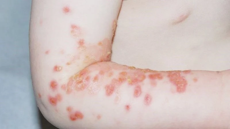 Hình ảnh ghẻ lở dễ nhầm với zona thần kinh