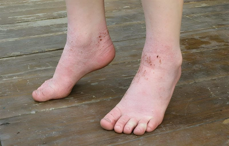 Hình dung rõ qua hình ảnh bệnh ghẻ nước chi tiết