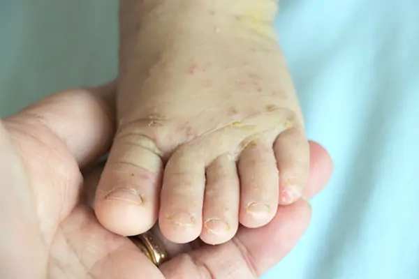 Nhận biết triệu chứng sớm ảnh trẻ sơ sinh bị ghẻ