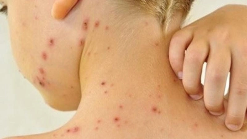 Khám phá triệu chứng qua hình ảnh người bị ghẻ