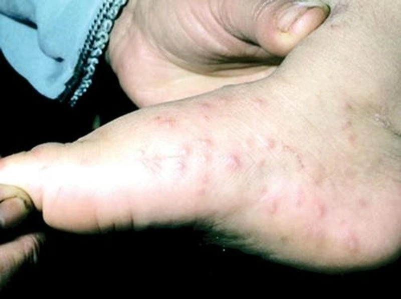 Làm sao nhận biết sớm trẻ em bị ghẻ dễ dàng