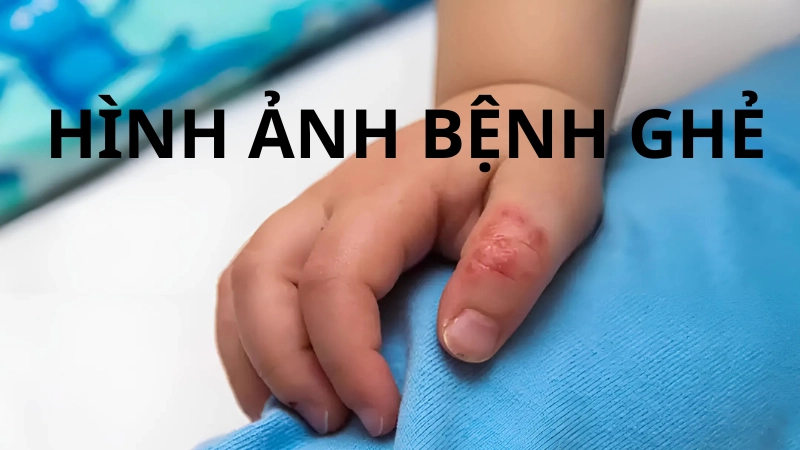 Hình ảnh bệnh ghẻ ở trẻ em giúp nhận biết sớm và chữa trị