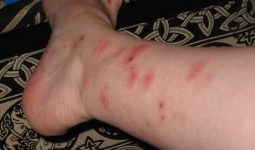 Hướng dẫn qua hình ảnh cách trị ghẻ ruồi hiệu quả