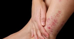 Tìm hiểu thực tế về thuốc trị ghẻ ruồi phổ biến