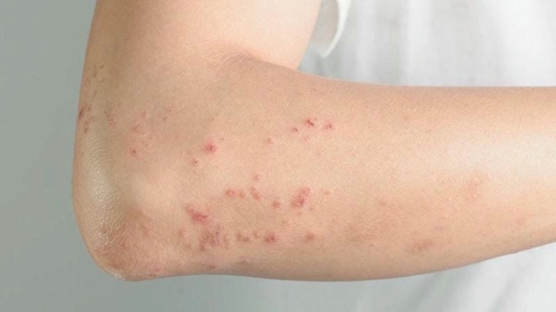 Quan sát chi tiết ảnh người bệnh ghẻ ruồi trên da