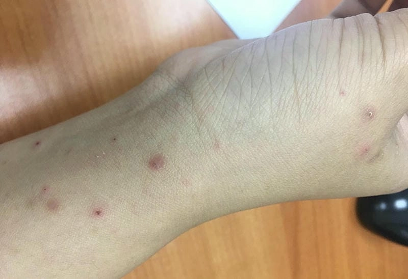 Minh họa rõ ràng hình ảnh người bị bệnh ghẻ ruồi