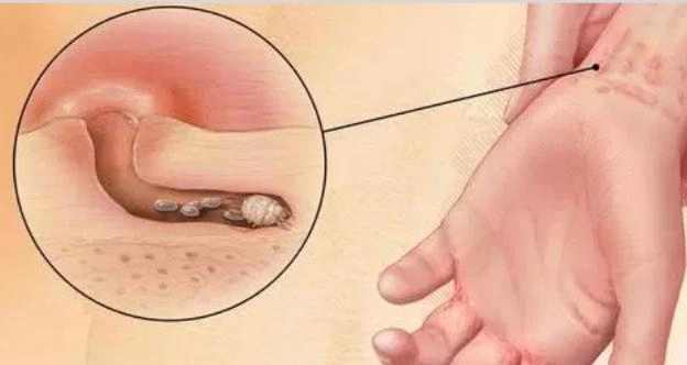 Hình ảnh thực tế ghẻ ruồi lan rộng trên cơ thể