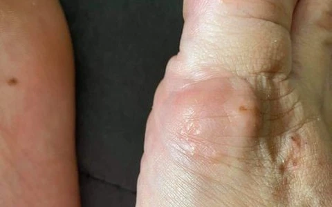 Quan sát nốt ghẻ ruồi qua hình ảnh thật