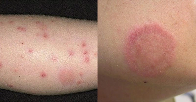 Tham khảo hình ảnh và mẹo ghẻ ruồi và cách trị hiệu quả