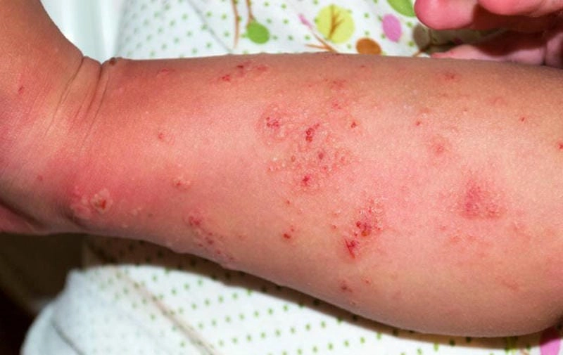 Hình ảnh minh họa thực tế về ghẻ ruồi ở người