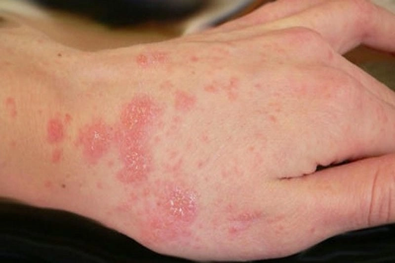 Tìm hiểu nguyên nhân và hình ảnh ghe ruoi thực tế