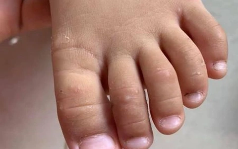 Hình ảnh thực tế ghẻ ruồi ở trẻ em dễ nhận biết