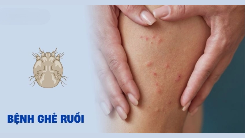 Nhận biết qua hình ảnh bệnh ghẻ ruồi ở người lớn và trẻ