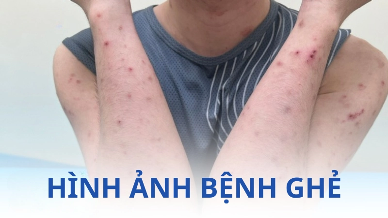 Tổng hợp hình ảnh bệnh ghẻ thật giúp bạn dễ nhận diện