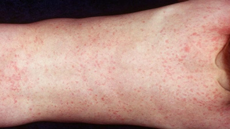 Cập nhật chi tiết bệnh giang mai hình ảnh