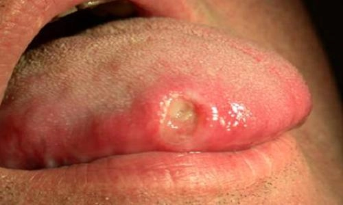 Bệnh giang mai là gì hình ảnh giúp hiểu rõ nguyên nhân và dấu hiệu