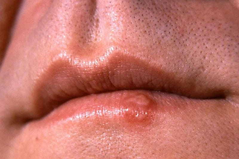 Chia sẻ rõ nét hình ảnh bệnh giang mai ở nam