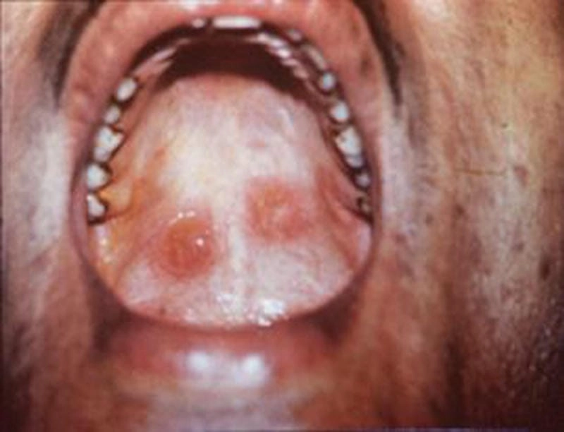 Cảnh báo hình ảnh bệnh giang mai nam nguy hiểm