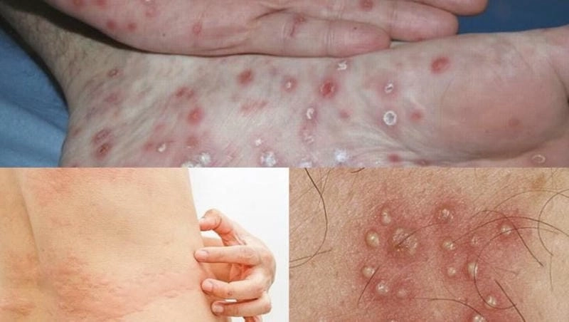 Cập nhật nhanh hình ảnh bệnh giang mai ở nữ giới