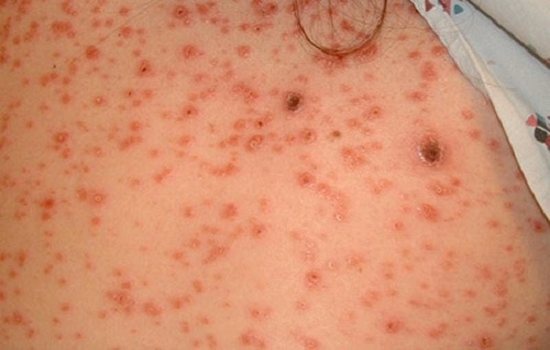 So sánh hình ảnh bệnh lậu giang mai dễ nhận biết