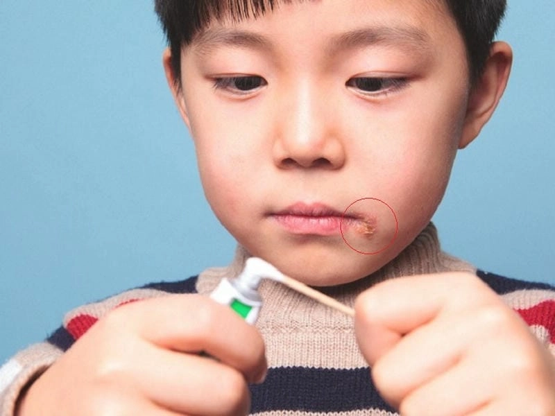 Hình ảnh của bệnh giời leo thường xuất hiện ở miệng