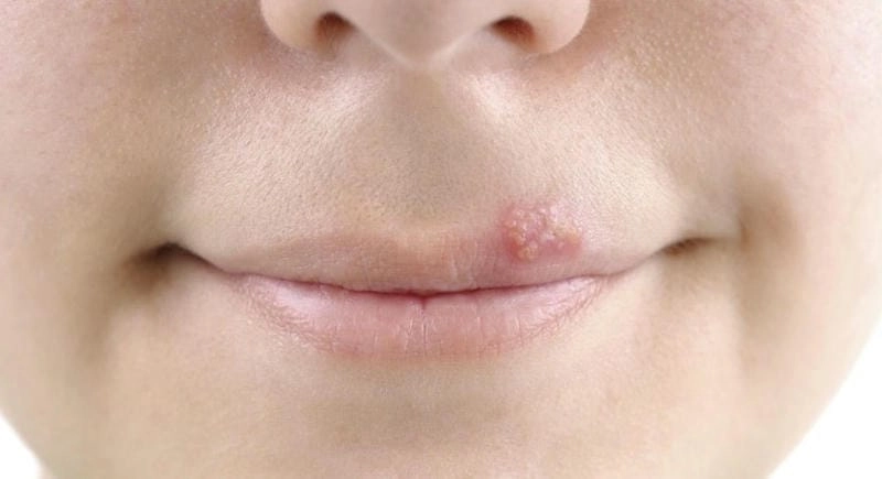 Hình ảnh bệnh giời leo thật từ ca mắc phổ biến