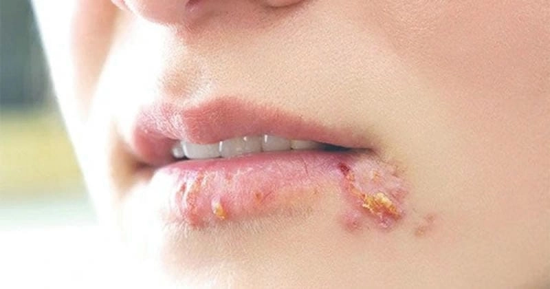 Cách điều trị hiệu quả cho hạ cam mềm