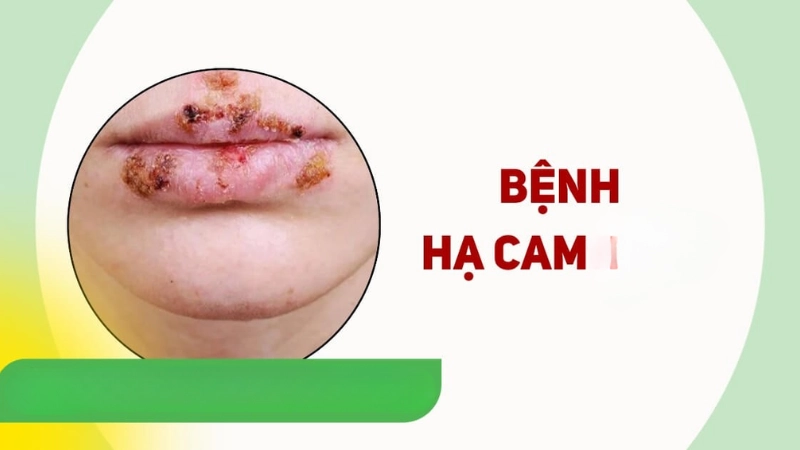 Hình ảnh bệnh hạ cam rõ nhất giúp nhận biết sớm triệu chứng