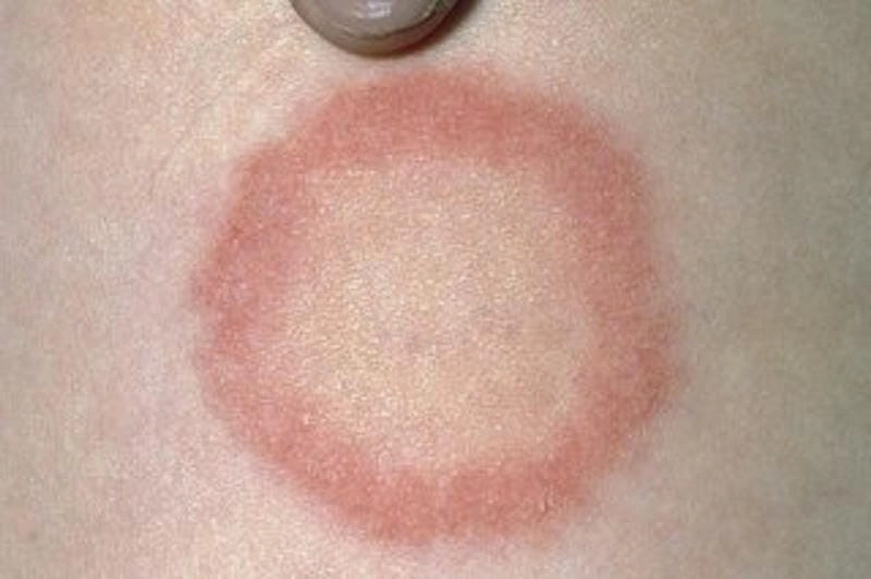 Cách chăm sóc khi bé bị hắc lào ngứa ngáy khó chịu
