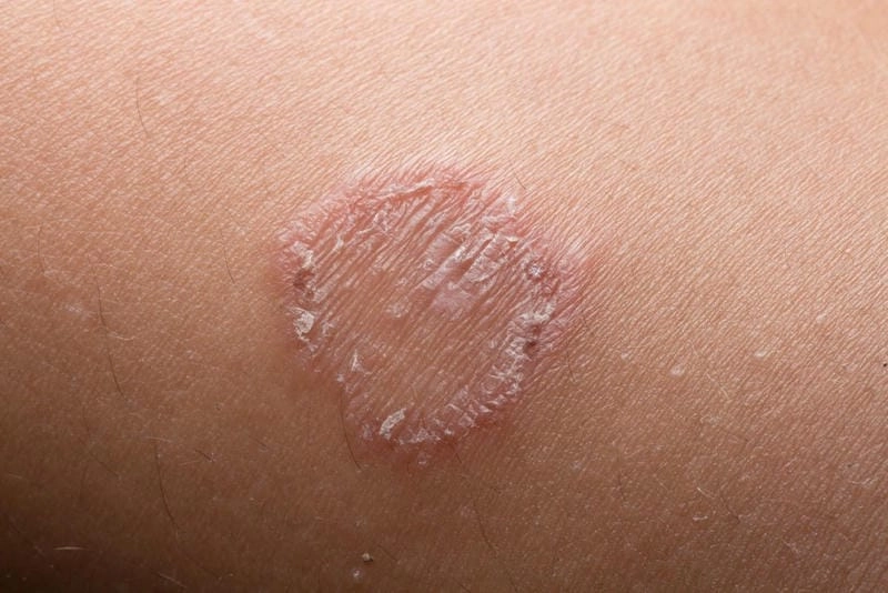Cùng xem hình ảnh bị bệnh hắc lào phổ biến ở Việt Nam