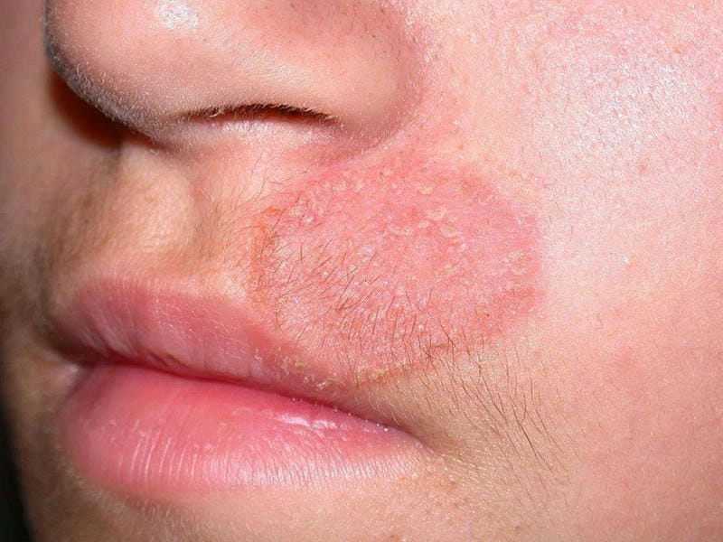Dấu hiệu nhận biết da mặt bị hắc lào dễ lây nhiễm
